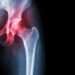 Stanford Researchers Discover Potential Way to Regrow Knee Cartilage by Blocking Aging-Related Protein
